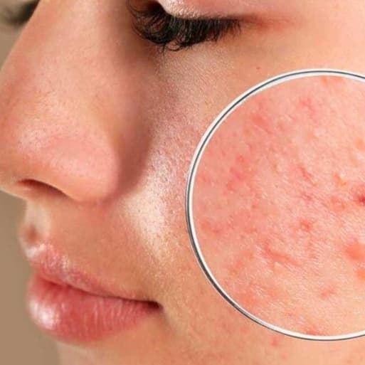Acne Control System at ShanaSkincare in Gainesville, FL